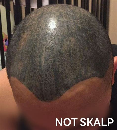 scalp micropigmentation regret|scalp micropigmentation gone wrong.
